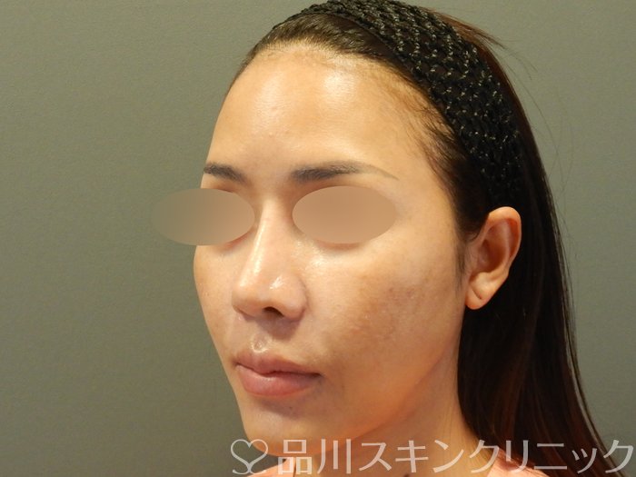 症例NO.65033のBEFORE写真