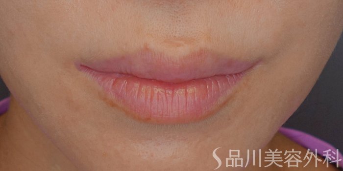 症例NO.71258のBEFORE写真