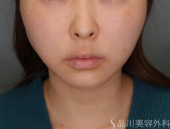 症例NO.54526のAFTER写真