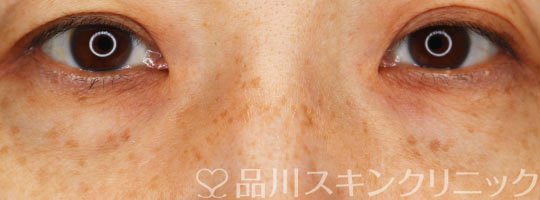 症例NO.70420のBEFORE写真