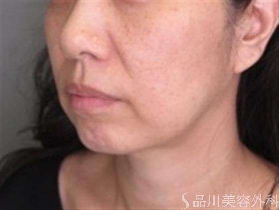 症例NO.48992のBEFORE写真
