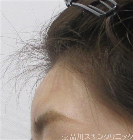 症例NO.32055のAFTER写真