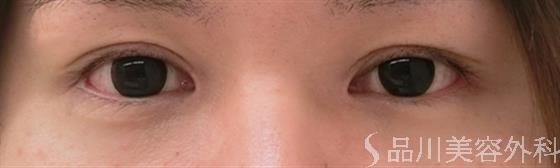 症例NO.26019のAFTER写真