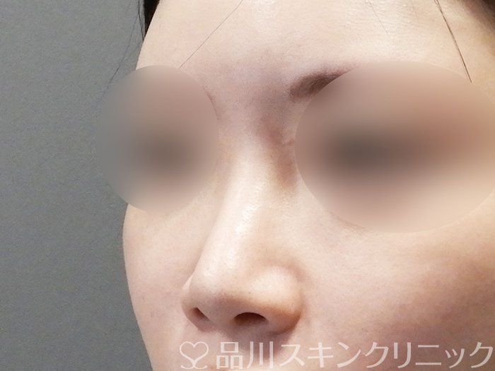 症例NO.72813のBEFORE写真