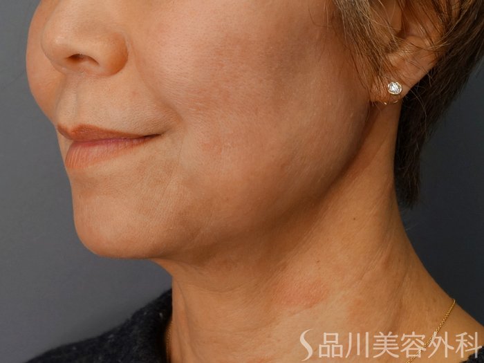 症例NO.72749のBEFORE写真