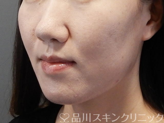 症例NO.71600のBEFORE写真