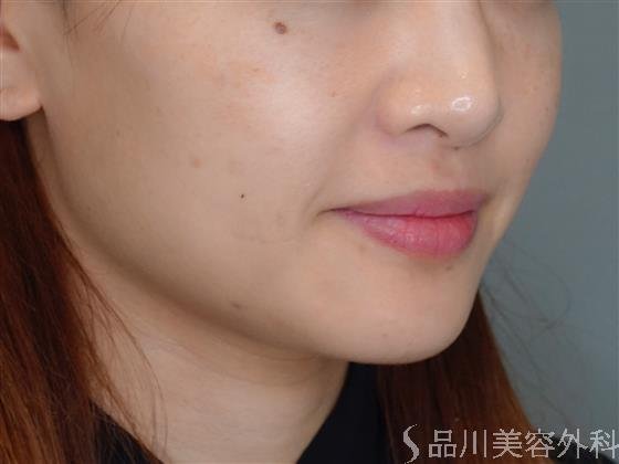 症例NO.50252のBEFORE写真