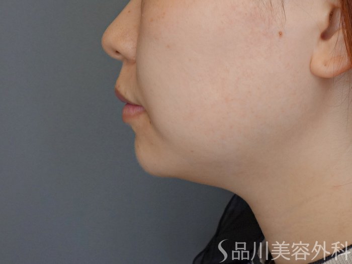 症例NO.72241のBEFORE写真