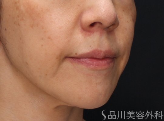 症例NO.72377のBEFORE写真