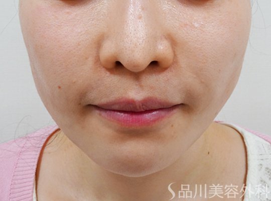 症例NO.73052のBEFORE写真