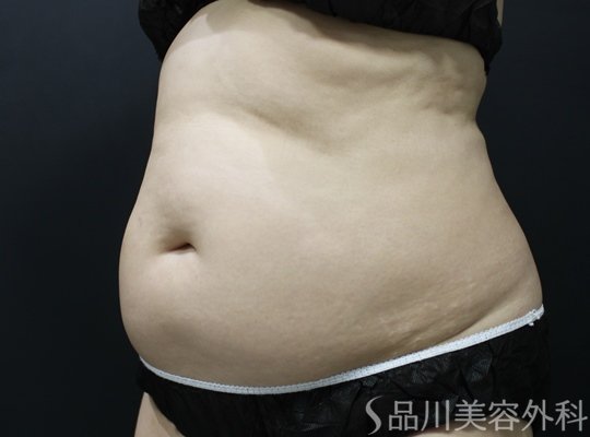 症例NO.75372のBEFORE写真