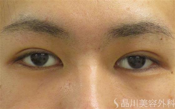症例NO.56103のAFTER写真