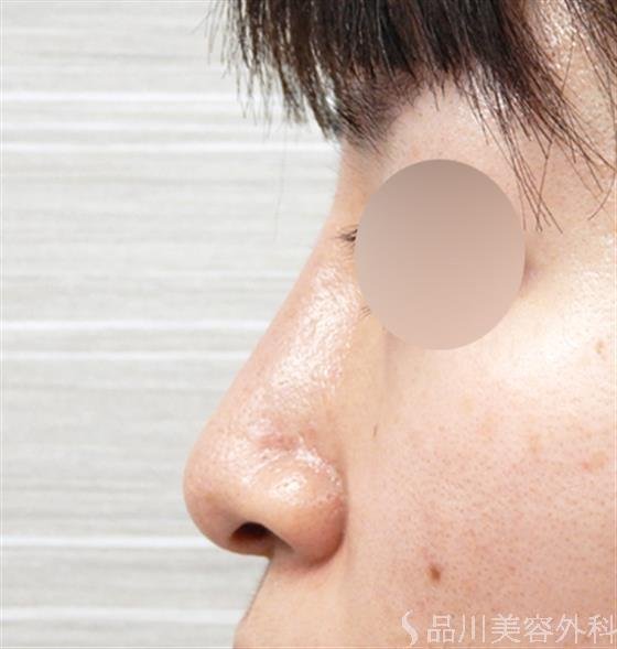 症例NO.53149のAFTER写真