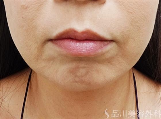 症例NO.34706のBEFORE写真