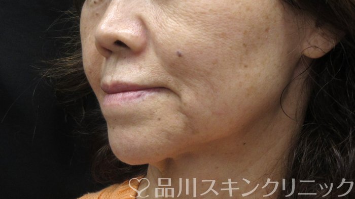 症例NO.73190のBEFORE写真