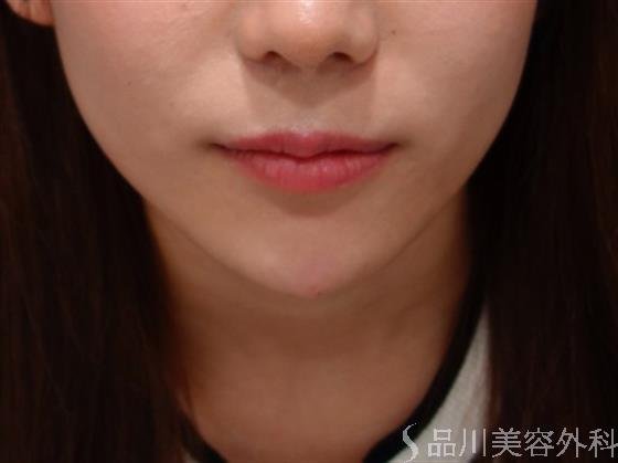症例NO.50616のAFTER写真