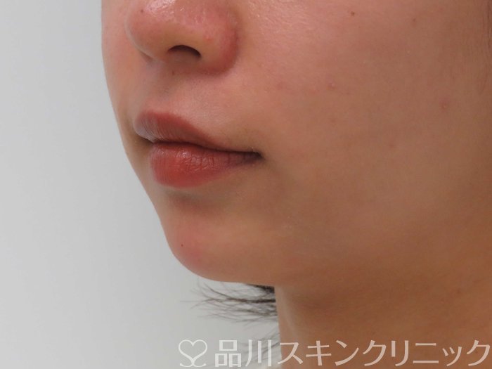 症例NO.71468のAFTER写真