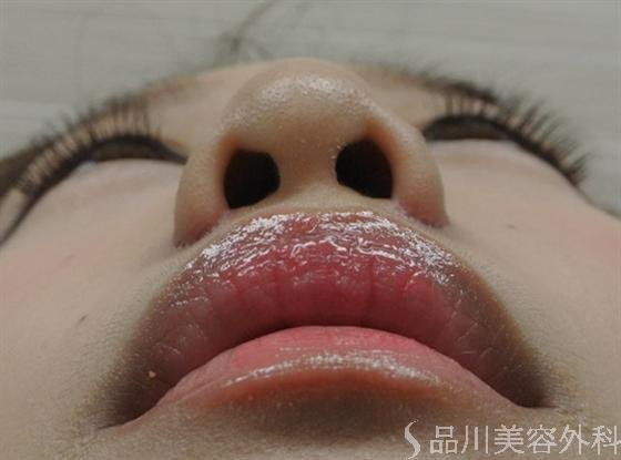 症例NO.16431のAFTER写真