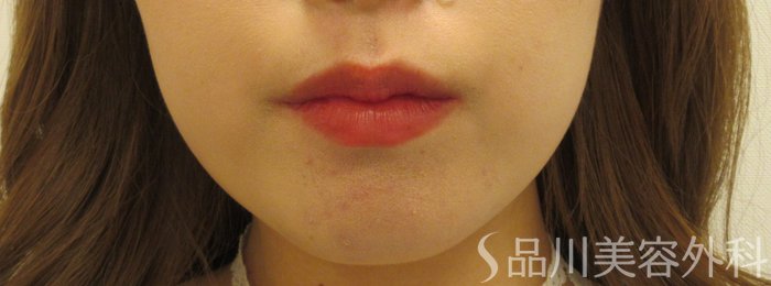症例NO.70916のBEFORE写真
