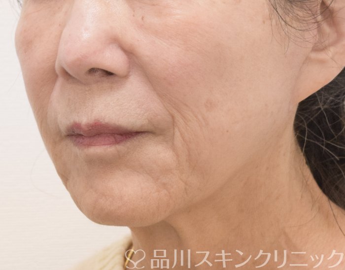 症例NO.73426のAFTER写真