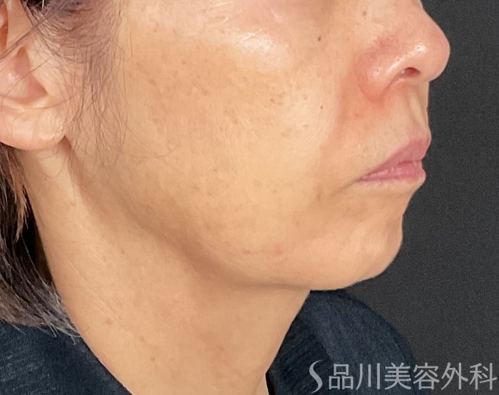 症例NO.74684のBEFORE写真