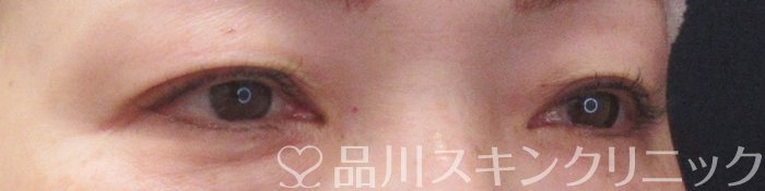 症例NO.70067のBEFORE写真