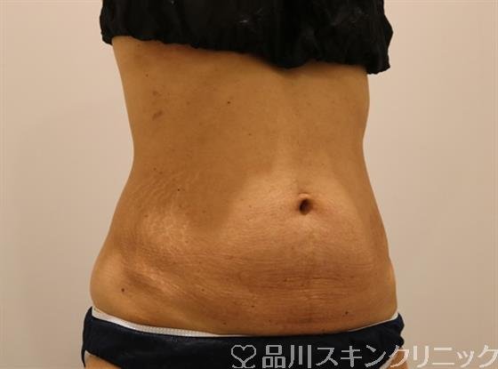 症例NO.42223のBEFORE写真