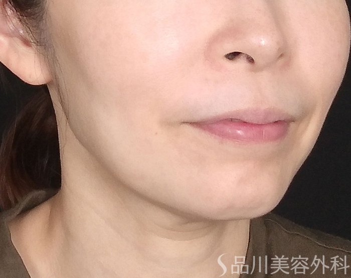 症例NO.70562のBEFORE写真