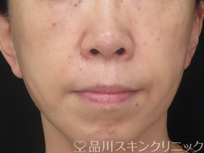 症例NO.70731のAFTER写真