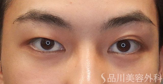 症例NO.74603のBEFORE写真