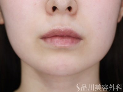 症例NO.69636のAFTER写真