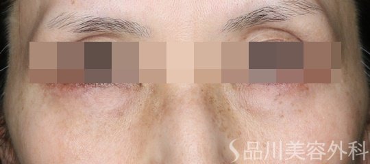 症例NO.69348のBEFORE写真