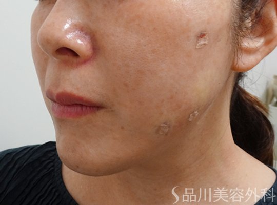 症例NO.72567のAFTER写真