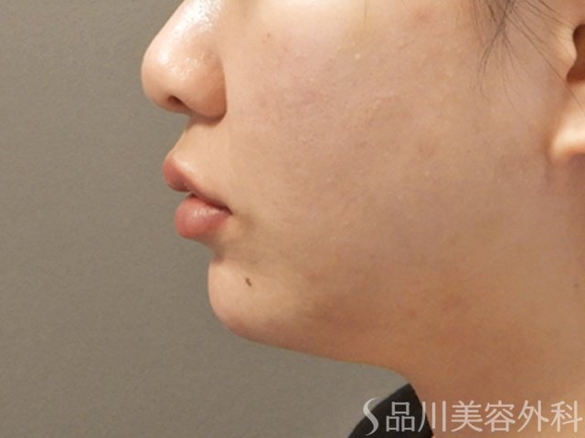 症例NO.71551のAFTER写真