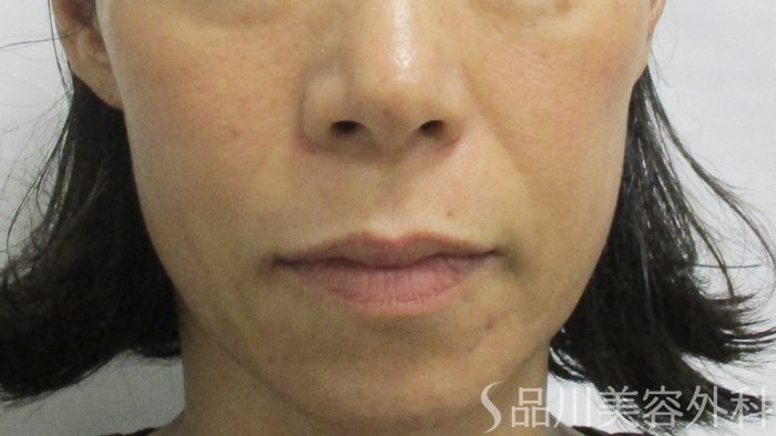 症例NO.63995のBEFORE写真