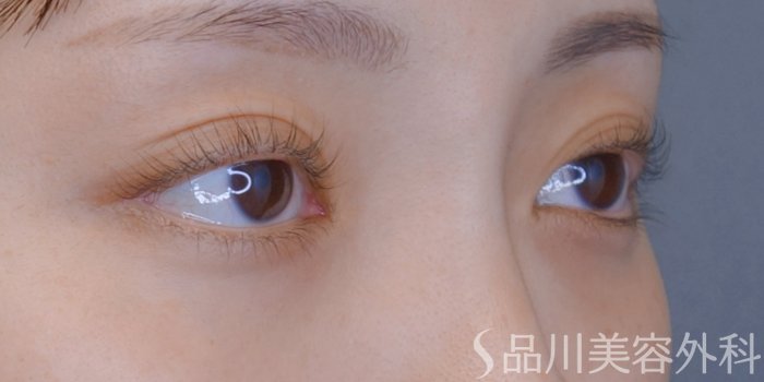 症例NO.73880のBEFORE写真
