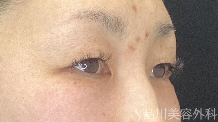症例NO.74323のBEFORE写真