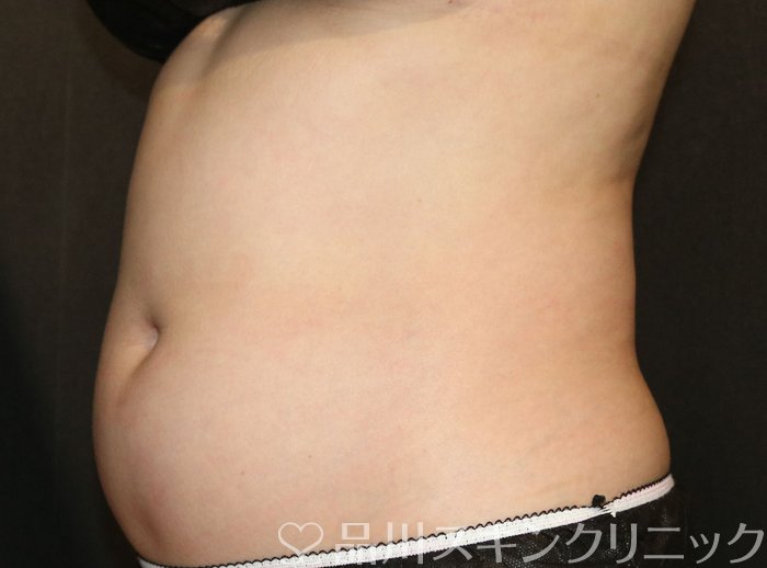 症例NO.65458のBEFORE写真