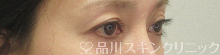 症例NO.71091のBEFORE写真