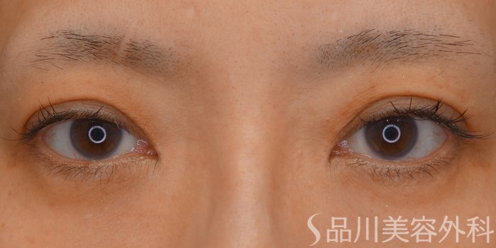 症例NO.68932のBEFORE写真
