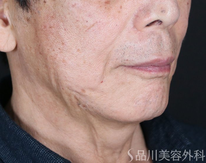 症例NO.73563のAFTER写真