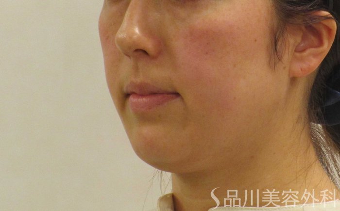 症例NO.65442のBEFORE写真