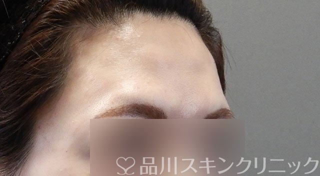 症例NO.63613のAFTER写真