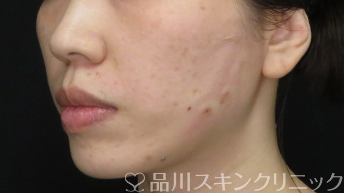症例NO.70866のAFTER写真