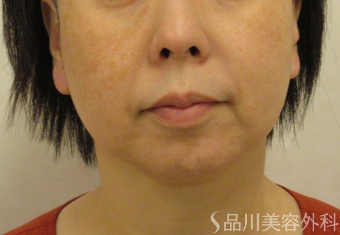 症例NO.71377のBEFORE写真