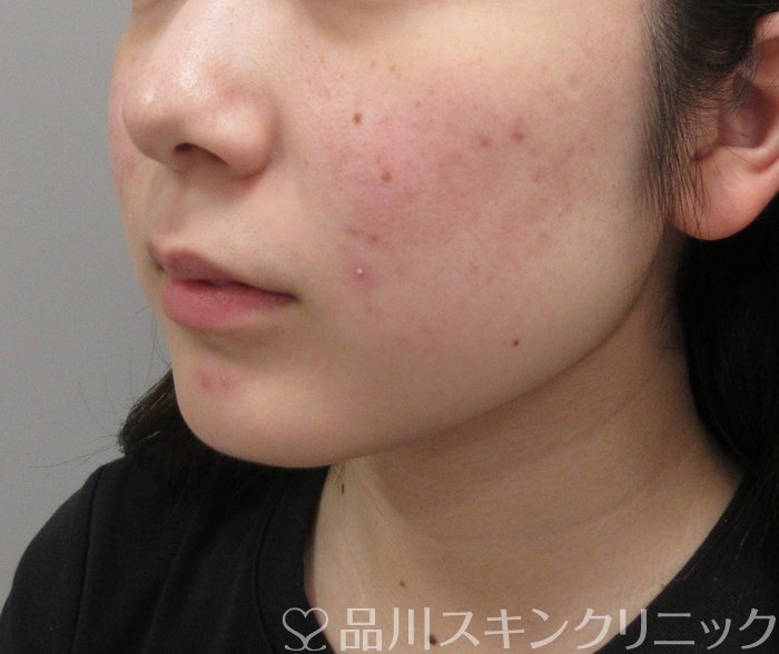 症例NO.73809のBEFORE写真