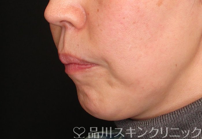 症例NO.74643のBEFORE写真