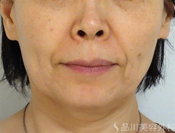 症例NO.43376のBEFORE写真