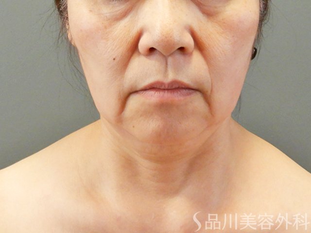 症例NO.67753のBEFORE写真