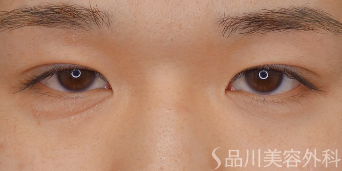 症例NO.72581のAFTER写真